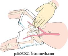 Drawing demonstrating taking a femoral pulse in a child.