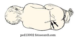 lumbar puncture position