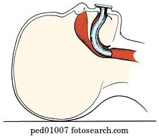 Drawing of Oropharyngeal Airway 3-Airway in Place orophar3 - Search ...