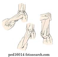 Drawing of Procedure for reduction of radial head subluxation (elbow ...