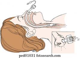 Drawings of Endotracheal Intubation-Tube in Place endotub4 - Search ...