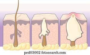 חתך לרוחב, של, בלוטה של שומן, של, ה, עור, להראות, שלושה, שלבים, ב, ה, התפתחות, של, acne.