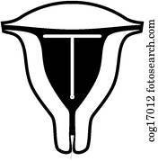 Intrauterine Device (IUD)