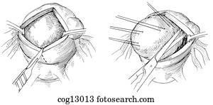 Drawings of Myomectomy, uterine, step 3 cog13014 - Search Clip Art ...