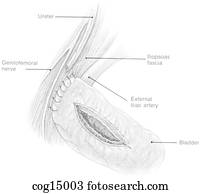 Ureter, bladder surgery