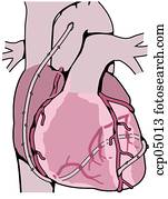 Bypass surgery, coronary