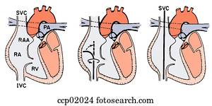 Stock Illustration of Catheterization, right heart, part 2 ccp02025 ...