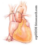 coração, transplantation