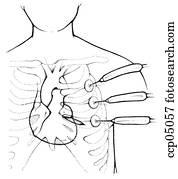 Surgery, coronary bypass