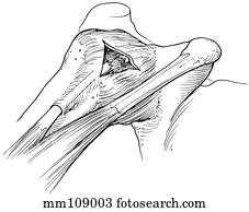 Rotator cuff, biceps tendon tears