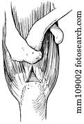 Rotator cuff tear