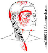 Sternocleidomastoid m., trigger points Sternocleidomastoid m., trigger points