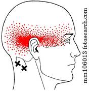 Suboccipital m., trigger points Suboccipital m., trigger points
