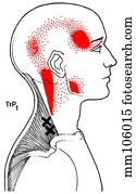 Trapezius m., trigger points Trapezius m., trigger points