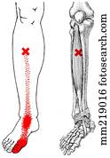 Tibialis Anterior Trigger Point