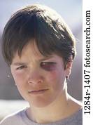people, injury, boy, outdoors, child, brunette people, injury, boy, outdoors, child, brunette