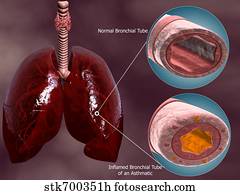Drawings of Drawing of bronchus showing constricted bronchioles; cross ...