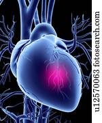 ataque cardíaco, conceitual, artwork