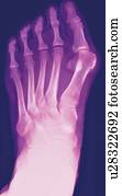 bunion, raio x