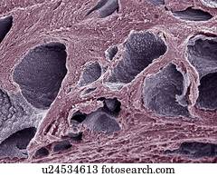 cancro da próstata, without