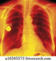 coração, marcapasso, raio x