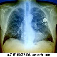 coração, marcapasso, raio x