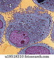 Leukaemia cells, TEM
