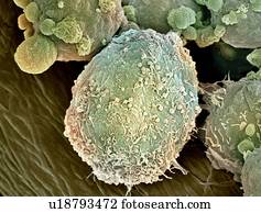 Lymphoma lymph cell, SEM