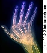 mão arthritic, raio x