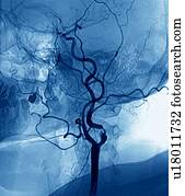 Narrowed neck artery, angiogram