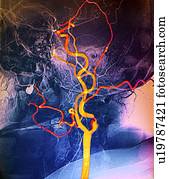 Narrowed neck artery, angiogram