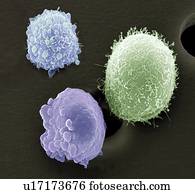 Skin cancer cells, SEM