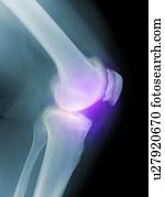 artrítico, joelho, raio x