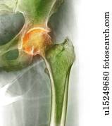 artrite, de, a, quadril, raio x