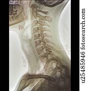 normal, pescoço, raio x