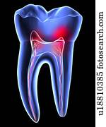 Tooth pain, toothache