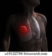 câncer pulmão, computador, artwork.