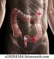 intestino, câncer, computador, artwork.