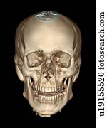 normal, skull., colorido, 3d, computado, tomografia, (CT), varredura, de, a, saudável, cranio, de, um, 36, ano velho, patient.