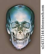 normal, skull., colorido, 3d, computado, tomografia, (CT), varredura, de, a, saudável, cranio, de, um, 36, ano velho, patient.