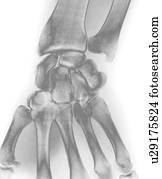 Normal wrist, X-ray. Normal wrist, X-ray.