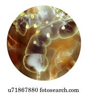 Diverticulitis, raio x