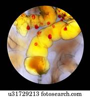 Diverticulitis, raio x