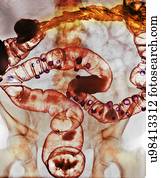 Diverticulitis, raio x