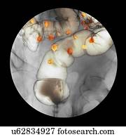Diverticulitis, raio x