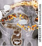 Diverticulitis, raio x