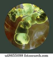 Diverticulitis, raio x