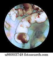 Diverticulitis, raio x