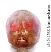 espingarda, ferimento, raio x