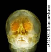 espingarda, ferimento, raio x